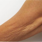 Ramiona – zagęszczenie skóry oraz redukcja nawisów skórnych