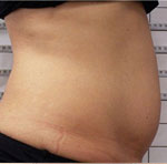 Brzuch – redukcja tkanki tłuszczowej, zmniejszenie obwodu, poprawa jędrności skóry
