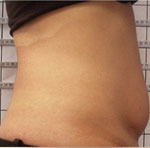 Brzuch – redukcja tkanki tłuszczowej, zmniejszenie obwodu, poprawa jędrności skóry